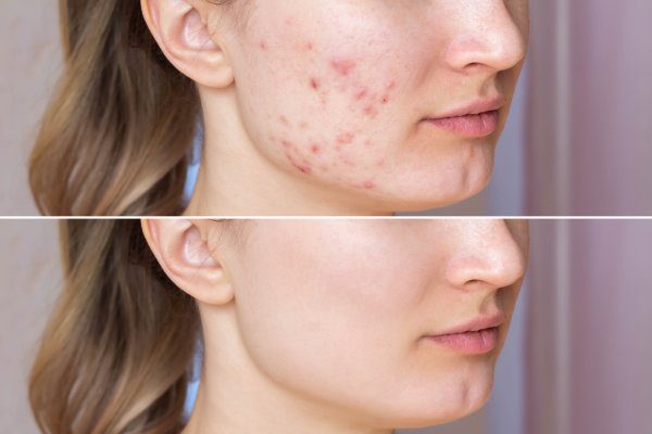 ACNE Solutions