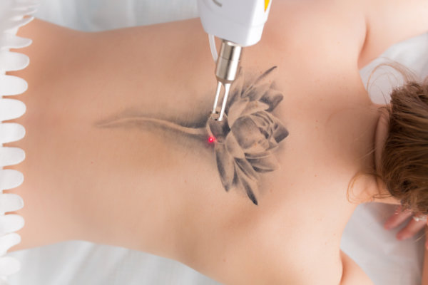 Back Tattoo Removal