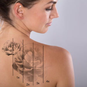 Laser Tattoo Removal On Woman's Shoulder